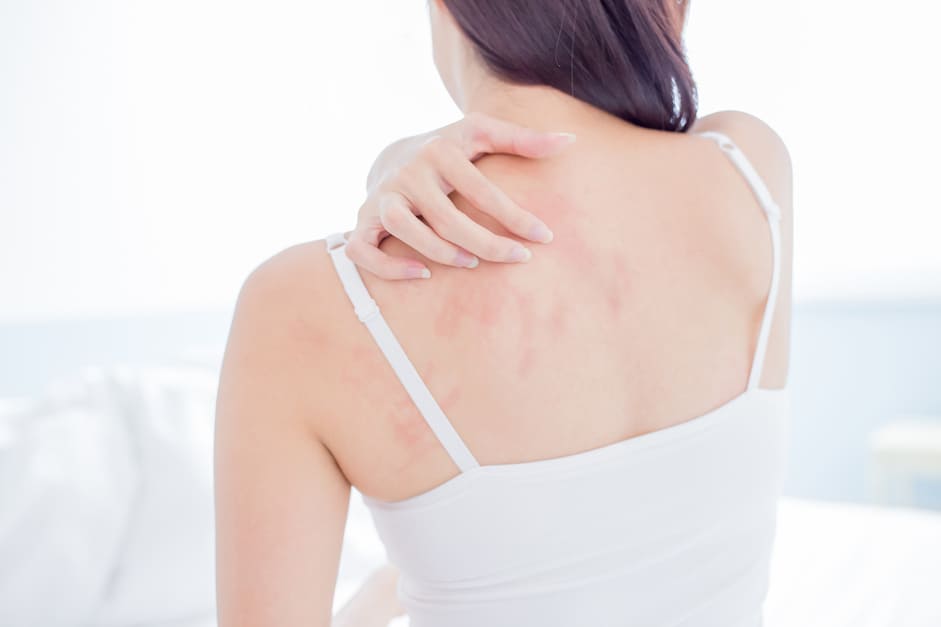 Lesiones elementales de la piel: una mujer con picor en la espalda