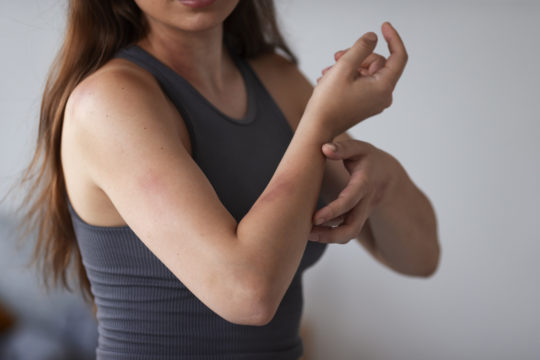 Eczema Treatment with women