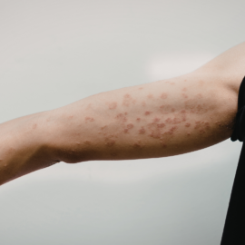 Comprensión de los cambios pigmentarios en la dermatitis atópica mediante el modelo de epidermis humana pigmentada reconstruida (RHPE) Atopic dermatitis flares and skin pigmentation changes